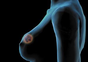 了解这些乳腺癌早期的症状