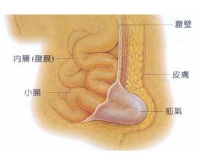 中医肿瘤医院讲解疝气这种病