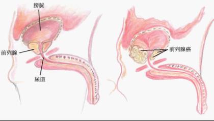 前列腺癌治疗