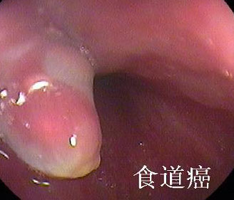 食道癌表现