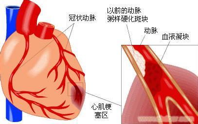 胆囊癌致癌的常见因素有哪些？