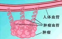 肿瘤血管抑制因子阻断疗法“饿死”癌细胞